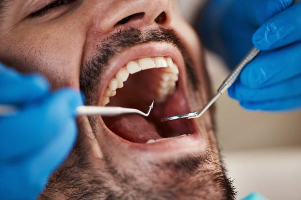 Best Emergency Wisdom Tooth Extraction in Somerdale, NJ